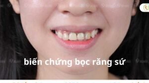biến chứng bọc răng sứ