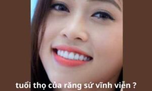 tuổi thọ của răng sứ vĩnh viễn